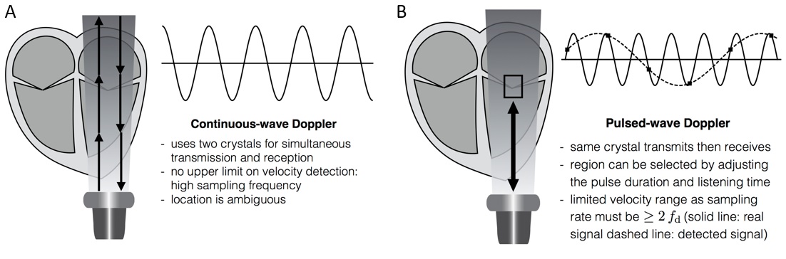 pulsed wave doppler